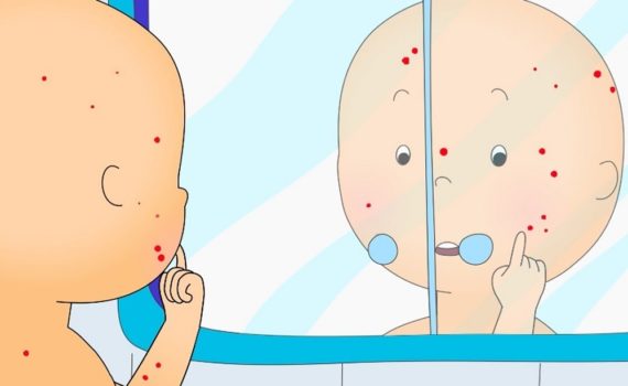 5 livres pour expliquer la varicelle